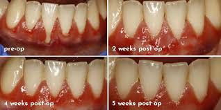 periodontal plastic surgery soft tissue