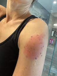 So far, side effects for both pfizer and moderna vaccines seem to be almost identical, apart from this one reaction. Mgh Researchers Call For Greater Awareness Of Delayed Skin Reactions After Moderna Covid 19 Vaccine
