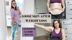 gastric byp weight loss journey