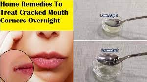 home remes for curing ed mouth
