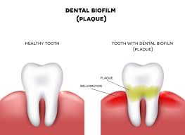 dental plaque benefits and