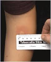 Tuberculin Skin Test Tst Minnesota Dept Of Health
