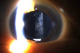 yag capsulotomy yag laser eye surgery