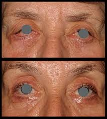 cataract surgery the oculoplastic factor