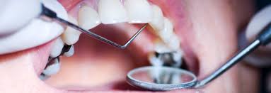Remember, not cleaning your teeth well, frequent snacking and sipping sugary drinks are the main culprits behind cavities. Dental Tooth Decay Treatment In India Dental Cavity Treatment Near Me