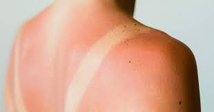 9 best sunburn treatments according to