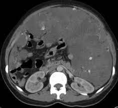 Maybe you would like to learn more about one of these? Malignant Peritoneal Mesothelioma Presenting As A Complex Omental Lesion Sciencedirect