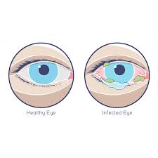 midtown optometry 3 types of pink eye