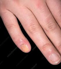 candidiasis of a fingernail stock