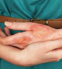 ice burn causes symptoms and treatment