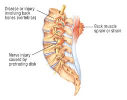 Muscular pain that comes on suddenly in your lower back is often indicative of a muscle spasm. Back Pain Harvard Health