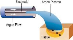 endobronchial argon plasma coagulation