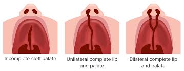 cleft lip and cleft palate concise