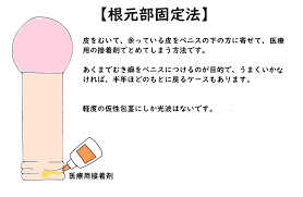 東京で包茎手術を受けるならココはずせない！東京包茎クリニック５選 | 脱・包茎メンズラボ
