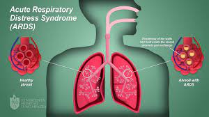 Learn more about the causes, risk factors, symptoms, complications, diagnosis. Ards Acute Respiratory Distress Syndrome St Vincent S Lung Health