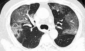 Chest Ct Findings Of Patients Infected
