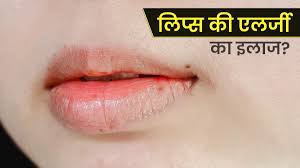 home remes to cure lips allergy in