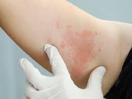 why do hives occur with hiv