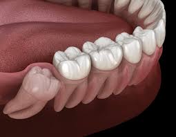 wisdom tooth pain slievemore dental