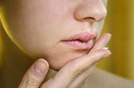 staph on lips causes symptoms and