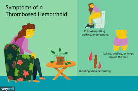 thrombosed hemorrhoid causes symptoms