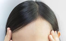 Ways to stop receding hair line. Receding Hairline How To Stop According To Ayurveda Vedix