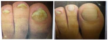 how to address toenail fungus the