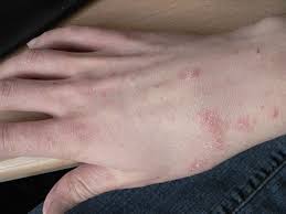 what is scabies images symptoms and