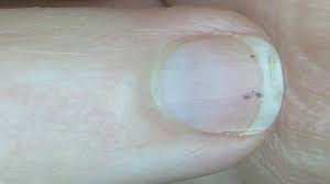 black line on the nail causes