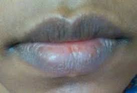dark lips treatment in delhi 1 1