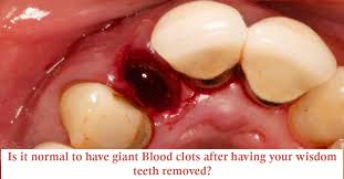 Looking after the wound properly can help a person to heal. Is It Normal To Have Giant Blood Clots After Having Your Wisdom Teeth Removed