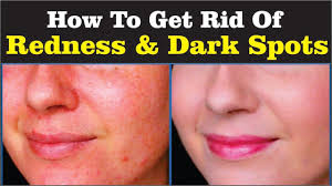 redness red spots from face