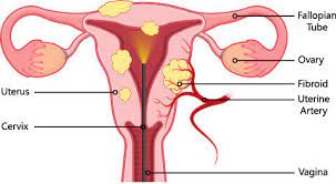Your belly may also be swollen. Myomectomy Obstetrics Gynecology Of Atlanta