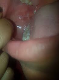 dentist for white patch inside mouth