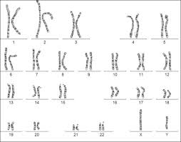 Y chromosome short tandem repeats. Neugeborener Junge Mit Ullrich Turner Syndrom Springerlink