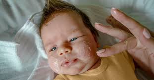 eczema on child s face causes