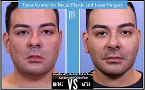 Maybe you would like to learn more about one of these? Botox Dysport For Men San Antonio Dr Jose Barrera