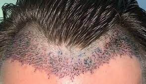 shedding after a hair transplant