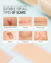 6 pack silicone scar sheets 1 57 5 9