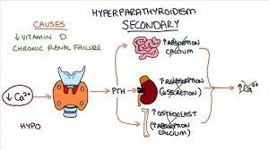 understanding hyperparathyroidism you