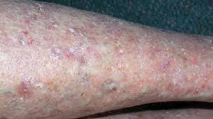 causes of red ps and spots on legs