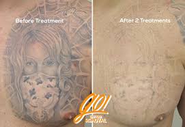 It could take up to a year before some patients realize complete removal. Getting Better Results Between Laser Tattoo Removal Treatments