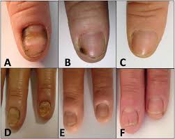 clinical results of onychomycosis