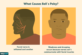 bells palsy symptoms causes