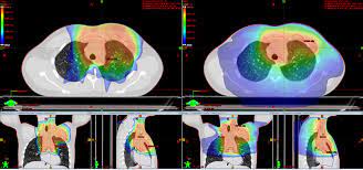 proton therapy for lymphomas cur