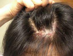 itchy scalp symptoms hair loss