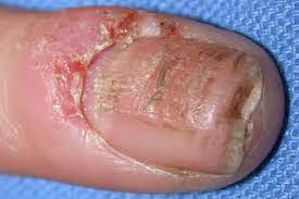 eczema on nails what it looks like