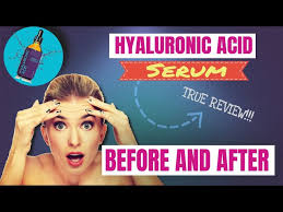 hyaluronic acid serum before and after