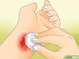 how to treat carpet burns with