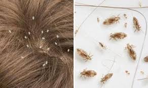 head lice facts and fallacies the